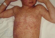 Mexico Registers 185 New Measles Cases During Opening Week of the World Cup